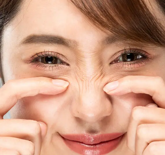 Junge Frau mit sichtbaren Bunny Lines beim Naserümpfen – typische Mimikfalten an der Nase, wie sie in Hamburg bei Dr. Hambarchian mit Botox behandelt werden